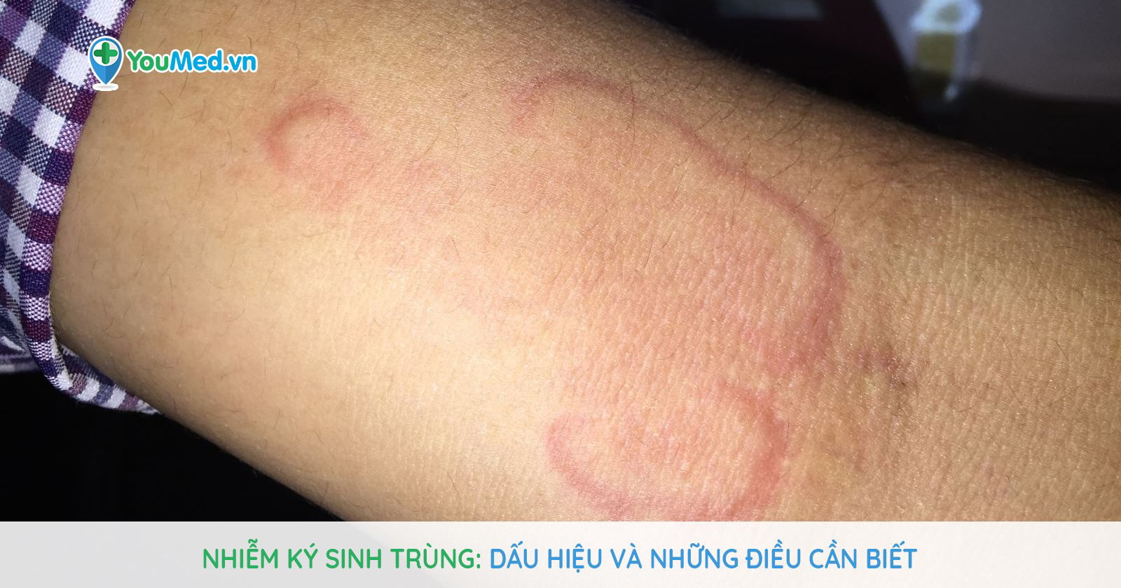 Nhiễm ký sinh trùng: Dấu hiệu nhận viết và cách điều trị - YouMed