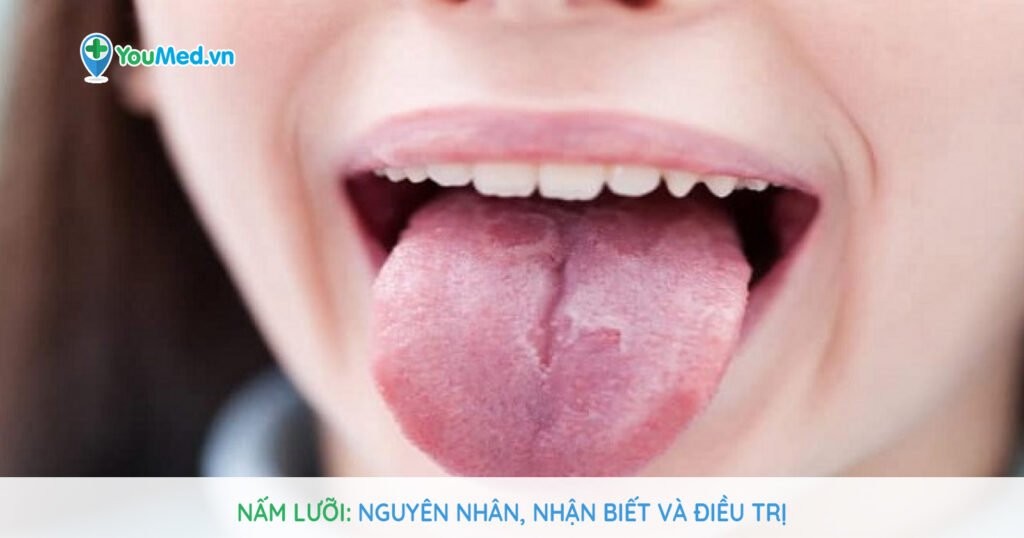 Nấm miệng (nấm lưỡi): Nguyên nhân, nhận biết và điều trị
