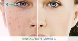 Tổng hợp các cách trị mụn trứng cá phổ biến nhất