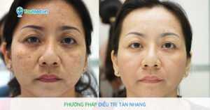 Phương pháp điều trị tàn nhang