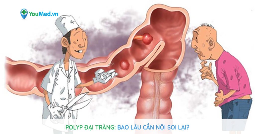 Polyp đại tràng: Bao lâu cần nội soi lại?