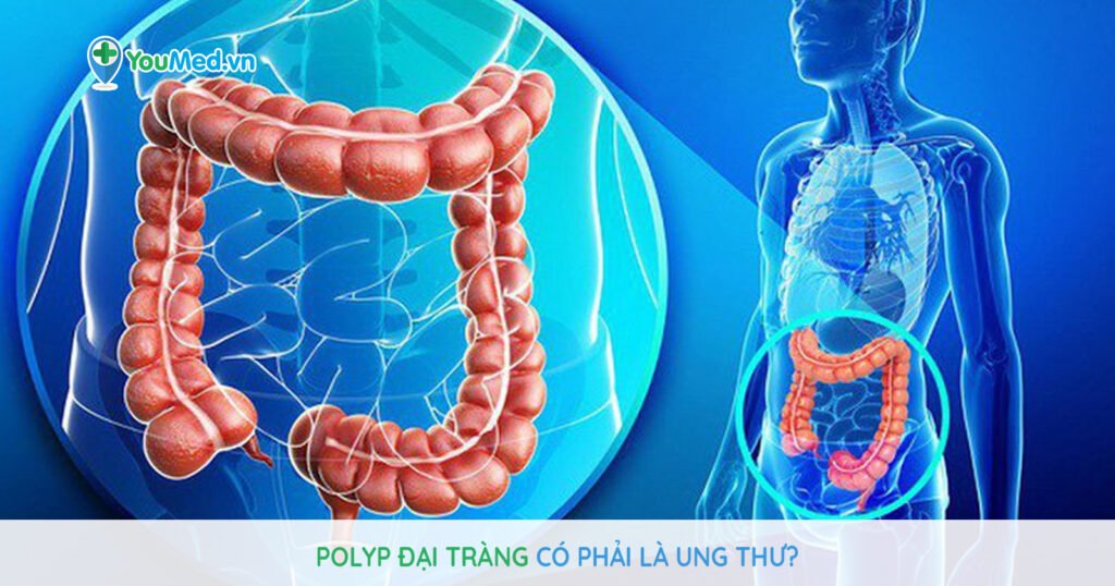 Polyp đại tràng có phải là ung thư?