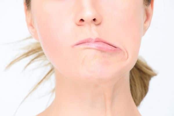 Khuôn mặt có vẻ bất thường hoặc lệch một bên là dấu hiệu dễ nhận biết nhất của bệnh thiếu máu não thoáng qua