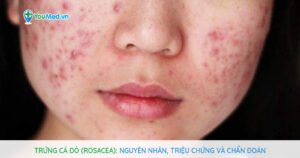 Trứng cá đỏ (Rosacea): Nguyên nhân, triệu chứng và chẩn đoán