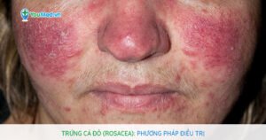 Trứng cá đỏ (Rosacea): Phương pháp điều trị như thế nào?