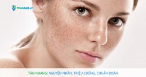 Tàn nhang: Nguyên nhân, chẩn đoán và điều trị