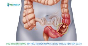 Ung thư đại tràng: Tìm hiểu nguyên nhân và lí do tại sao nên tầm soát?