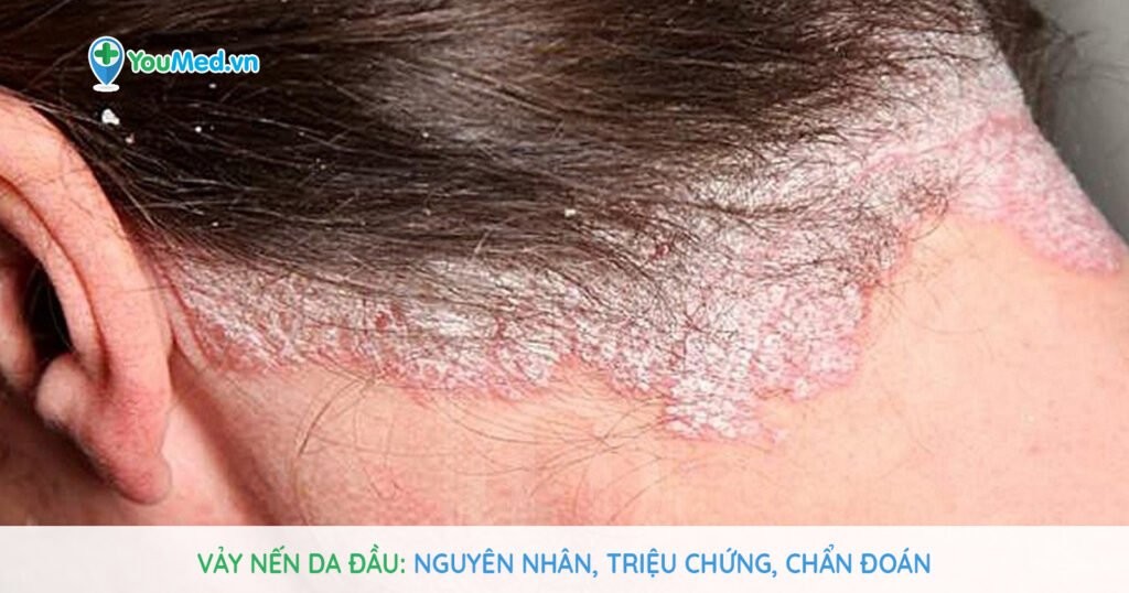 Vảy nến da đầu: Nguyên nhân, triệu chứng và cách điều trị