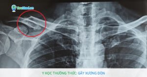 Y học thường thức: Gãy xương đòn