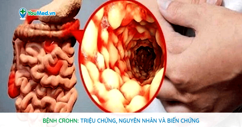 Bệnh Crohn: Triệu chứng, nguyên nhân và biến chứng