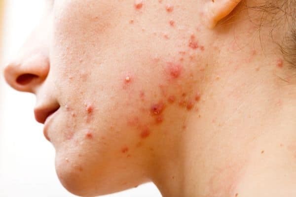 Nang lông phình to dẫn đến vỡ và gây nên các mụn viêm trên da