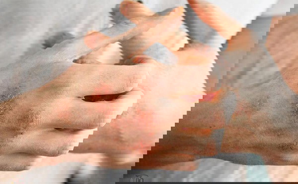 Chàm xuất hiện trên da thường do yếu tố gen và yếu tố môi trường gây nên