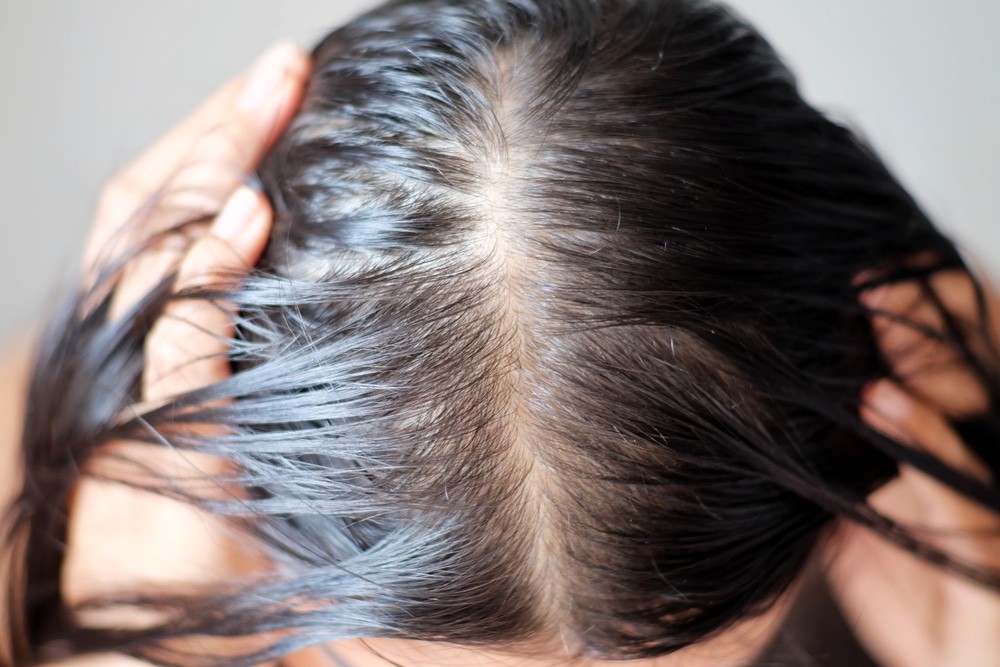 Rụng tóc lan tỏa ở bệnh nhân đợt bùng phát lupus ban đỏ