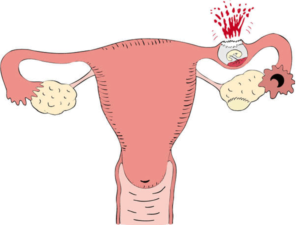 Khi thai ngoài tử cung phát triển, sẽ gây chèn ép dẫn đến vỡ vòi trứng