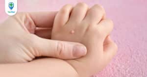 Nguyên nhân và cách trị mụn cóc hiệu quả & an toàn