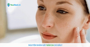 Khám phá nguyên nhân gây nám da ở phụ nữ