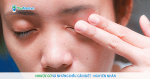 Bệnh nhược cơ là gì? Tìm hiểu về nguyên nhân gây bệnh