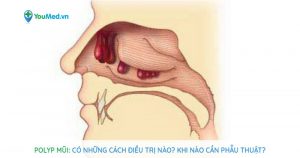 Polyp mũi: Có những cách điều trị nào? Khi nào cần phẫu thuật?