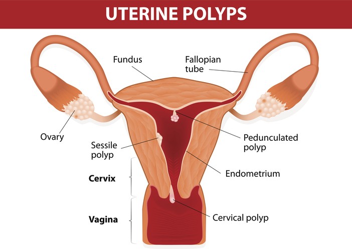 U xơ cơ tử cung và polyp tử cung 