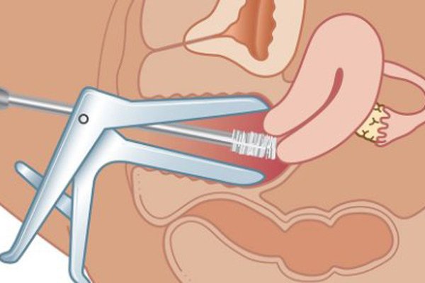 Xét nghiệm tế bào cổ tử cung Pap’s test