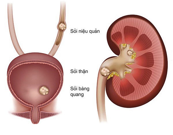 Sỏi tiết niệu, yếu tố nguy cơ quan trọng gây nhiễm trùng tiểu