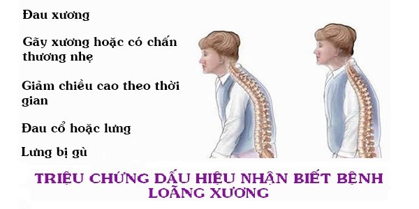 Triệu chứng loãng xương