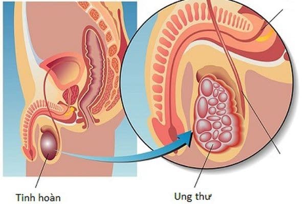 Tùy vào tình trạng ung thư tinh hoàn của bệnh nhân, bác sĩ sẽ đưa ra các phương pháp điều trị phù hợp