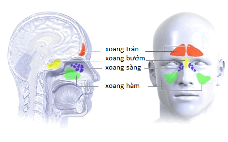 viêm xoang
