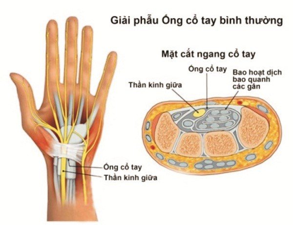 hội chứng ống cổ tay 1