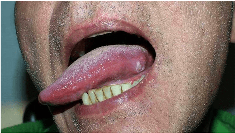 Vết loét trên bề mặt lưỡi có thể là biểu hiện của ung thư lưỡi