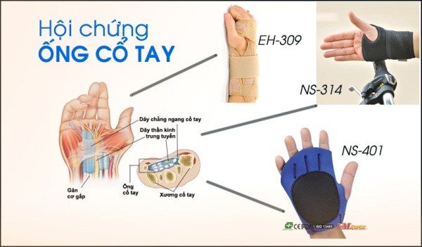 hội chứng ống cổ tay 2