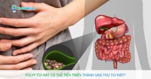 Polyp túi mật có thể tiến triển thành ung thư túi mật?