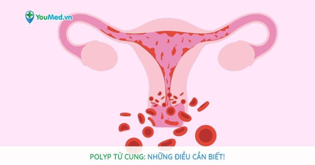 Polyp tử cung: Những điều cần biết!