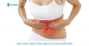 Sán lá gan: Triệu chứng, điều trị và cách ngăn chặn