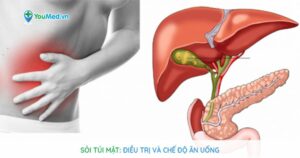 Sỏi túi mật nên ăn gì và kiêng ăn gì?