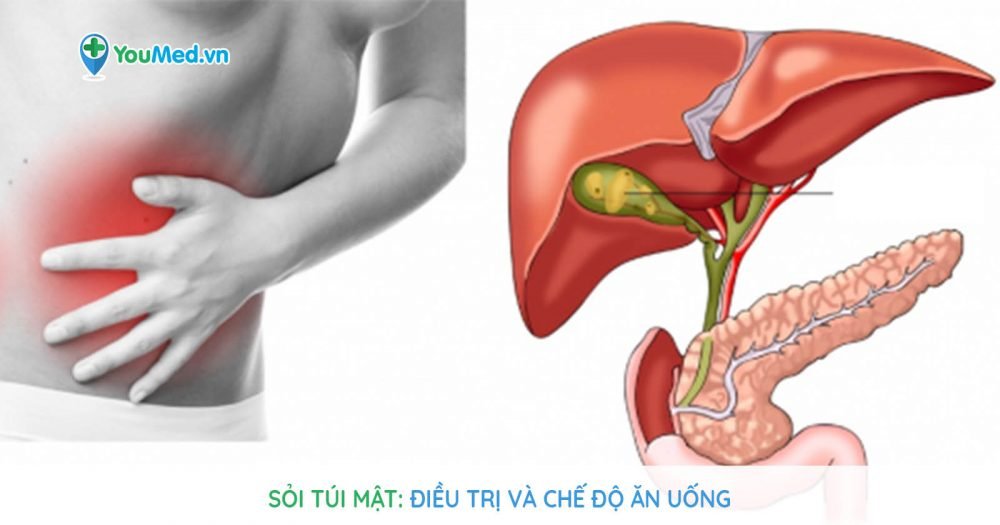 Sỏi túi mật: Điều trị và chế độ ăn uống - YouMed