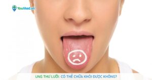 Ung thư lưỡi có chữa khỏi được không?