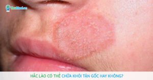 Hắc lào có thể chữa khỏi tận gốc hay không?