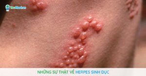 Những sự thật về Herpes sinh dục