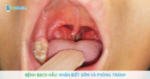Bệnh bạch hầu: Nhận biết sớm để điều trị và phòng tránh