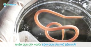 Nhiễm giun đũa người: Bệnh giun sán phổ biến nhất