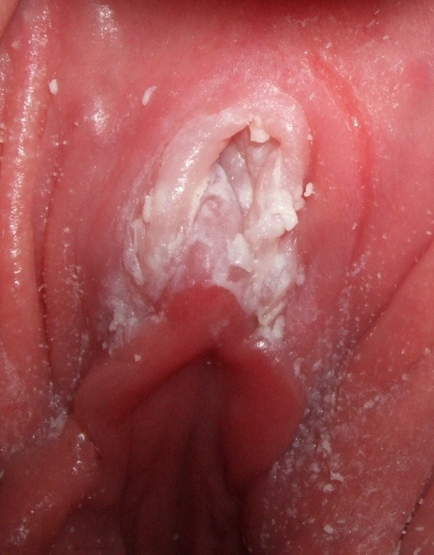 Viêm âm đạo do Candida thường gây dịch tiết màu trắng, có kết cấu sệt ở âm đạo