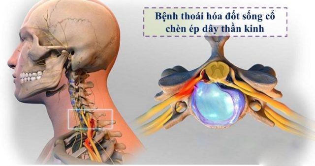 Thoái hóa đốt sống cổ có thể gây chèn ép thần kinh và gây đau