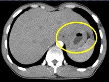 CT scan có cản quang thấy thành dạ dày có hiện tượng dày lên bất thường, dấu hiệu của sự thâm nhiễm lan tỏa bướu dạ dày.