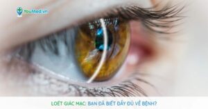 Loét giác mạc : Bạn đã biết đầy đủ về bệnh?