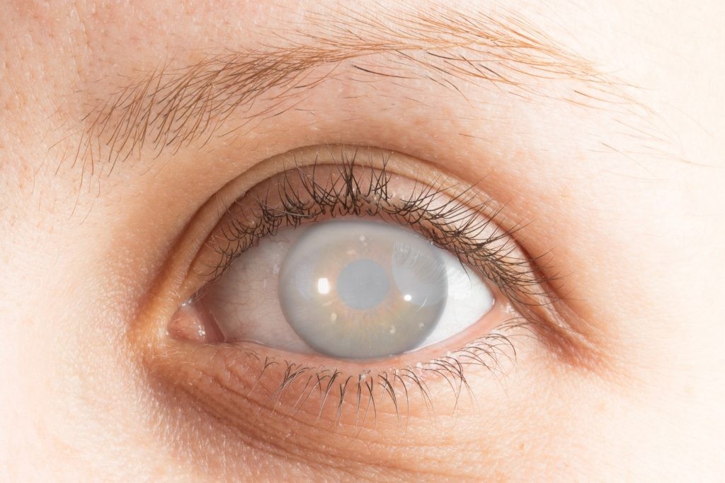 Đục thủy tinh thể bẩm sinh (ở mắt phải của trẻ) có thể dẫn tới nhược thị