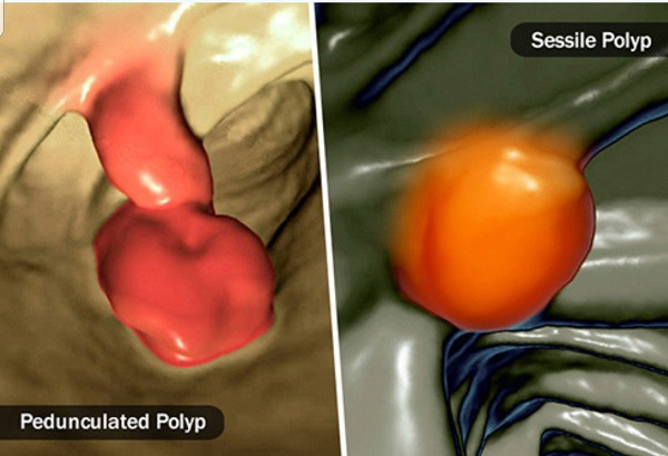 Polyp dạ dày