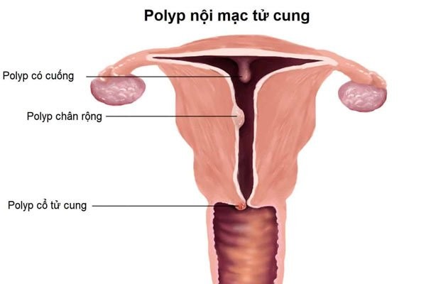 Lớp nội mạc tử cung là lớp tế bào lót mặt trong tử cung