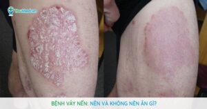 Bệnh vảy nến: Nên và không nên ăn gì?