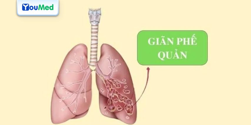 Thuốc Combivent: Cách sử dụng và các lưu ý cần biết